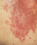 Cloth Diaper Rash: How to get rid of a recurring yeast problem.