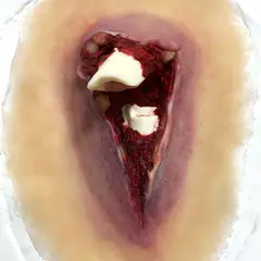 Techline Technologies Compound Fracture