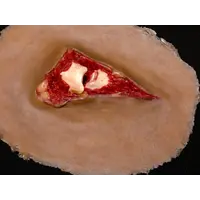 Techline Technologies Compound Fracture