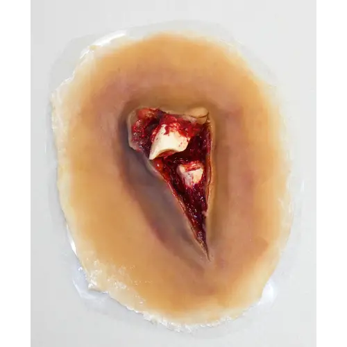 Techline Technologies Compound Fracture