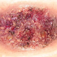 Techline Technologies Thermal Burn - Large