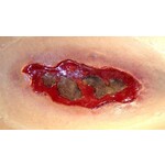 Techline Technologies Electrical Burn - Large