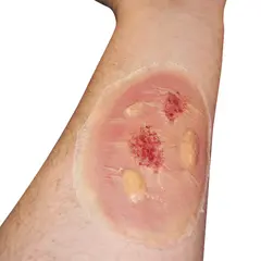 Techline Technologies Thermal Burn - Medium