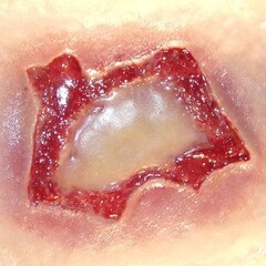 Techline Technologies Chemical Burn - Medium