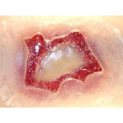 Techline Technologies Chemical Burn - Medium