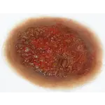 Techline Technologies Burn - 2nd Degree