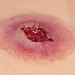 Techline Technologies GS Entry Wound - Large