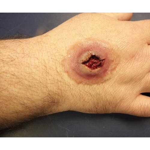 Techline Technologies GS Entry Wound - Large