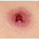 Techline Technologies GS Entry Wound - Small