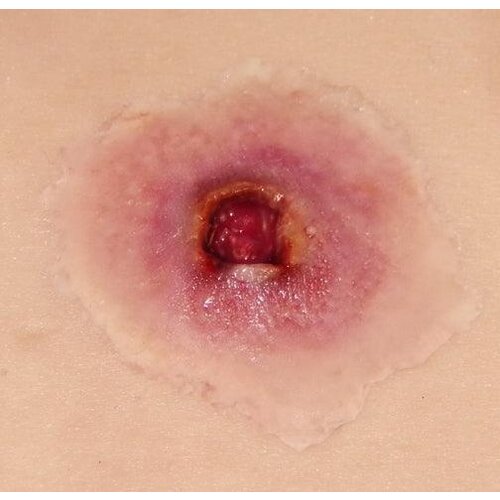 Techline Technologies GS Entry Wound - Small