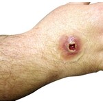 Techline Technologies GS Entry Wound - Small