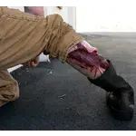 Techline Technologies Avulsion to Calf