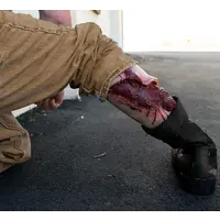 Techline Technologies Avulsion to Calf