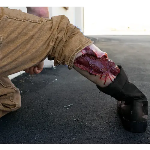 Techline Technologies Avulsion to Calf