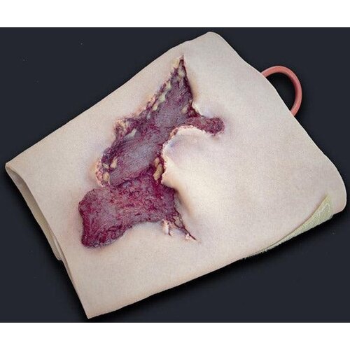 Techline Technologies Avulsion to Calf