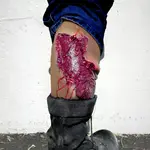 Techline Technologies Avulsion to Calf