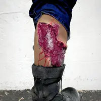 Techline Technologies Avulsion to Calf