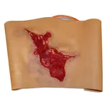 Techline Technologies Avulsion to Calf