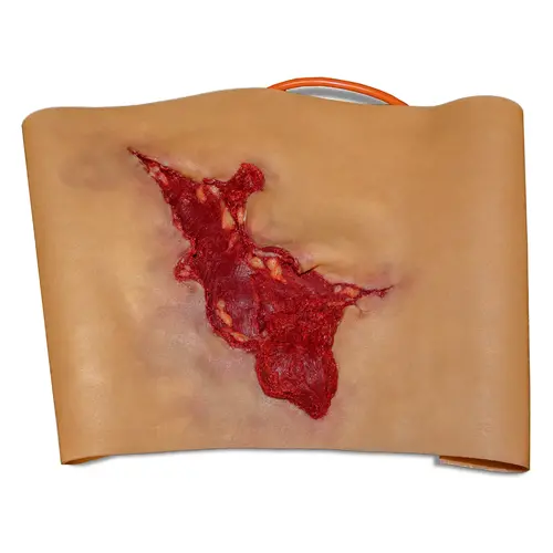 Techline Technologies Avulsion to Calf