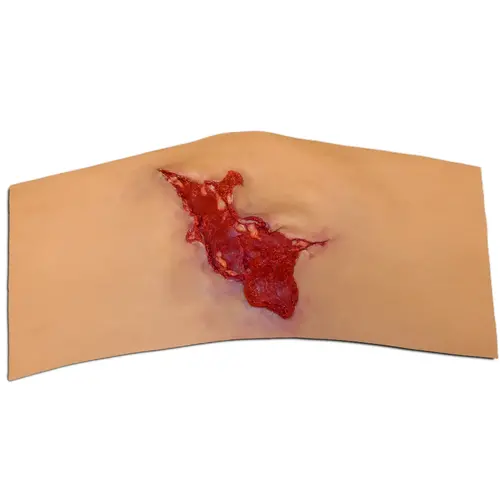 Techline Technologies Avulsion to Calf