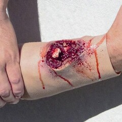 Techline Technologies Compound Arm Fracture