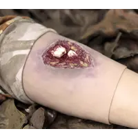 Techline Technologies Compound Arm Fracture