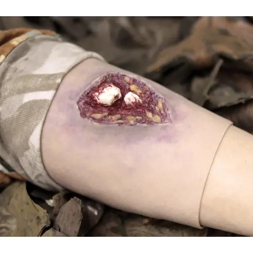 Techline Technologies Compound Arm Fracture