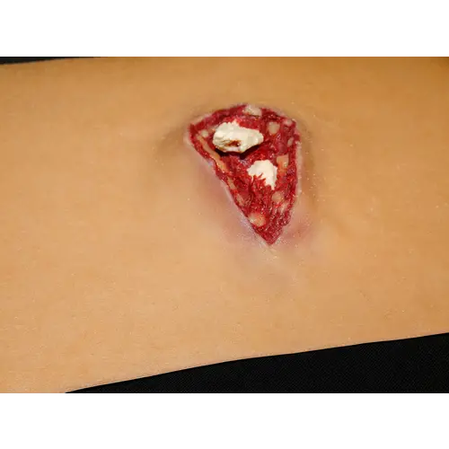 Techline Technologies Compound Arm Fracture