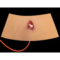 Techline Technologies Compound Arm Fracture