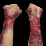 Techline Technologies Severe Right Burn Glove