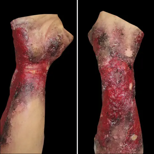 Techline Technologies Severe Right Burn Glove