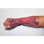 Techline Technologies Severe Right Burn Glove