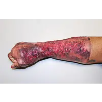 Techline Technologies Severe Right Burn Glove