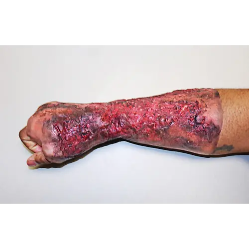 Techline Technologies Severe Right Burn Glove