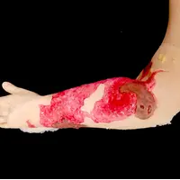 Techline Technologies Burn Arm Full Debrided