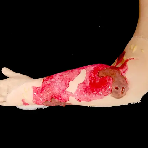 Techline Technologies Burn Arm Full Debrided
