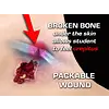 Techline Technologies Gunshot Wound Clavicle