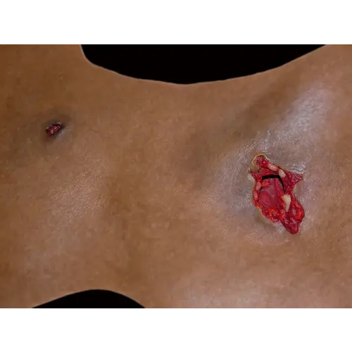 Techline Technologies Gunshot Wound Clavicle