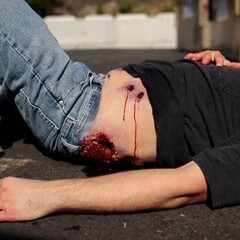 Techline Technologies Multiple Gunshot Abdomen