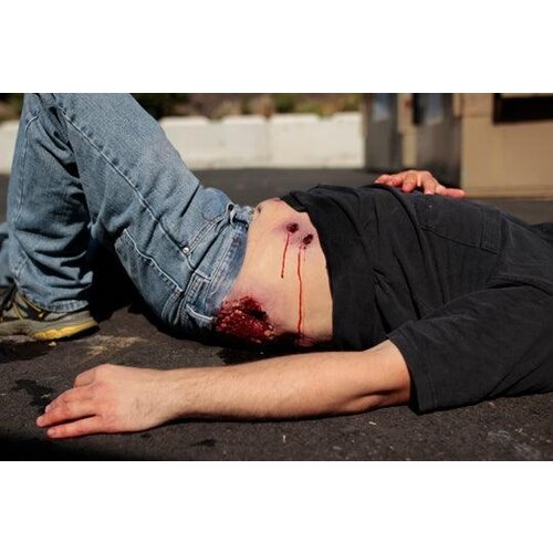 Techline Technologies Multiple Gunshot Abdomen