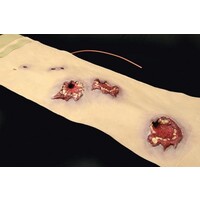 Techline Technologies Multiple Gunshot Abdomen