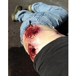 Techline Technologies Multiple Gunshot Abdomen