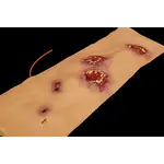 Techline Technologies Multiple Gunshot Abdomen
