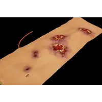 Techline Technologies Multiple Gunshot Abdomen