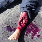 Techline Technologies Patrial Left Leg Amputation