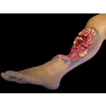 Techline Technologies Patrial Left Leg Amputation