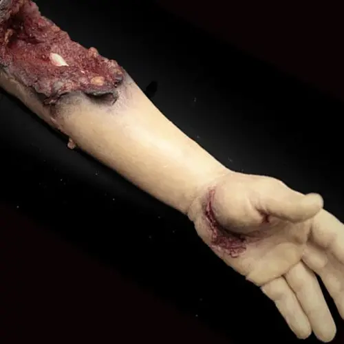 Techline Technologies Partial Left Arm Amputation