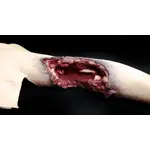 Techline Technologies Partial Left Arm Amputation
