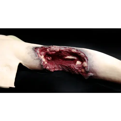 Techline Technologies Partial Left Arm Amputation