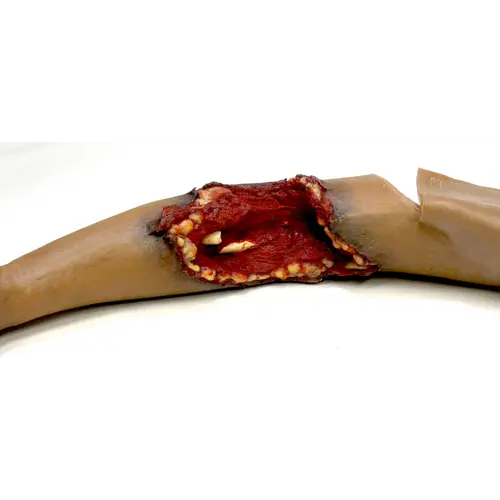 Techline Technologies Partial Left Arm Amputation